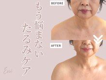 エニ(Eni)/たるみ改善・フェイスライン変化
