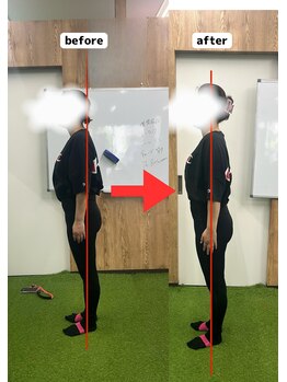 ネーム鍼灸整骨院 春日 本郷三丁目院/反り腰でお悩みのOさん