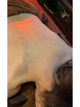 ハリアージュ(Hariage)の写真/【磐田旧国沿いにOPEN】鍼は初めてという方にも◎貸切個室で国家資格保持者の優しく丁寧な本格美容鍼灸を
