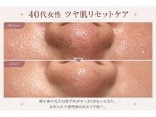 フラワー(FLOWER)/40代女性　ツヤ肌リセット 1回目