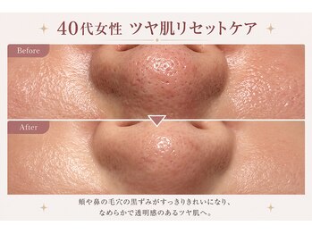 フラワー(FLOWER)/40代女性　ツヤ肌リセット 1回目