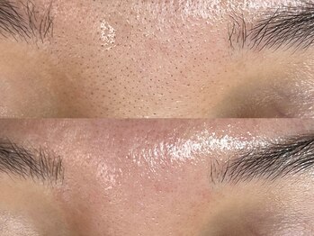 フレーズ(fraise)/毛穴エクストラクション