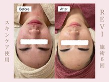 ルア(LuA.)/美白◎