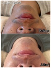 エイチビー(HB)/髭脱毛４回の効果