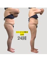 ミテ(Mite)/サイズダウン痩身　70代