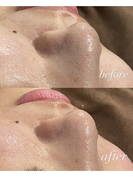 チル(chill)/アクアピーリング