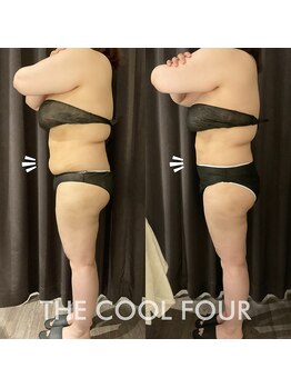 ローザー トウキョウ(Lowther Tokyo)/脂肪冷却