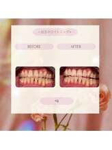 プラスビーセルフ(+b self)/ホワイトニングビフォーアフター