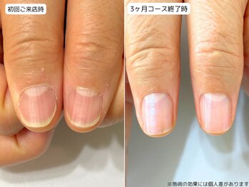 カピリナ(Ka Pilina)/自爪育成・深爪・川崎