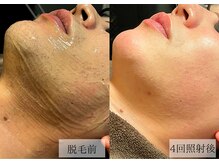 メンズアルファ/【髭】光脱毛before after 30代