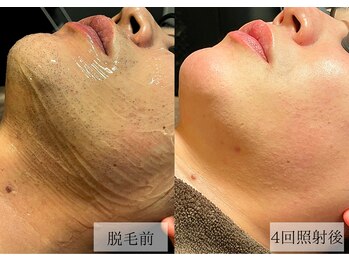 メンズアルファ/【髭】光脱毛before after 30代