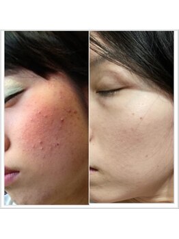 ヴィオラ(Viola)/ニキビケアもお任せ下さい★