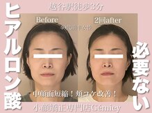 ジェイミー(Gemiey)/ヒアルロン酸いらずです！！