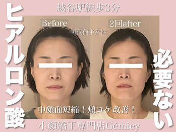 ジェイミー(Gemiey)/ヒアルロン酸いらずです！！