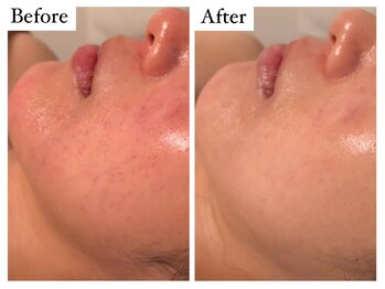 リナート(Rinato)/REVIハーブピーリング