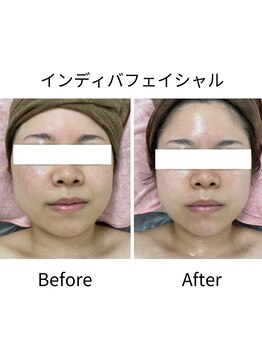 ナタリー(Natalie)/インディバフェイシャル