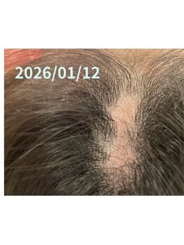 サクランボ(SAKURAMBO)/諦めないで！頭皮の傷口ケア☆