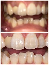 コントレール 歯ぁと(CONTRAIL)/1回のペーストLEDでとれました