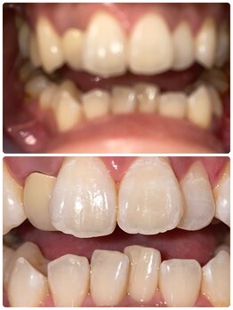 コントレール 歯ぁと(CONTRAIL)/1回のペーストLEDでとれました
