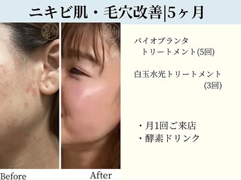 京都フォーエイチ(京都4H)/肌質改善ビフォーアフター