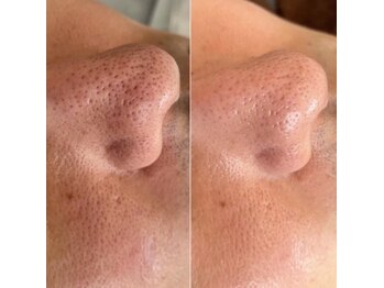 サロン ド プレジール(Salon de Plaisir)の写真/【メンズ美肌専門店】皮脂汚れ/古い角質/黒ずみ毛穴改善◎すっきり爽快毛穴洗浄◎若見え＆清潔感溢れる肌へ