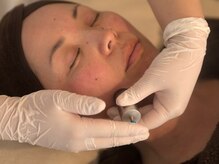 皇漢堂鍼灸療院/最新美容鍼【ダーマ鍼】の流れ-3