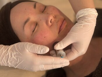 皇漢堂鍼灸療院/最新美容鍼【ダーマ鍼】の流れ-3