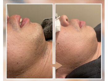 プルベル 平尾(Plus Belle)/ヒゲ脱毛