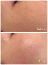 ククル(KUKULU)/陶肌ピール3回目♪（40代女性）