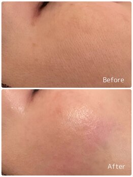 ククル(KUKULU)/陶肌ピール3回目♪(40代女性)