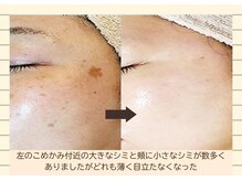 ソワン/プラズマシミケア/6回目