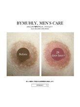 モア(more.)/黒ずみケア一回の変化29日後