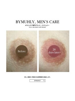 モア(more.)/黒ずみケア一回の変化29日後