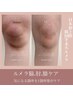 【ルメラ選べる1部位】ワキ/ひじ/ひざの黒ずみケアに ¥98,000→¥50,000