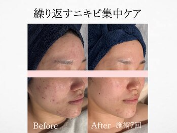 アンドミルル(and Milulu)/【繰り返すニキビ集中ケア】