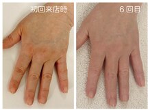 キレイテ 上野店/40代/6回目【上野ハンドケア】