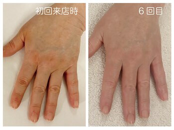 キレイテ 上野店/40代/6回目【上野ハンドケア】