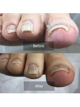 ドクターネイル爪革命 北千住店/巻き爪ケア