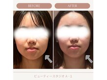 ビューティースタジオ エイワン(A1)の雰囲気（Before/After★小顔矯正＆リンパマッサージ+フォーカスソニック）