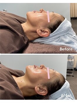 おおむら鍼灸接骨院/フェイシャル Before＆After