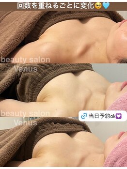 ヴィーナス(Venus)/バストアップ(痩身効果◎整体◎