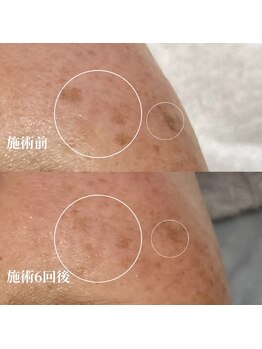 サロンドベルム(Salon de BELME)/シミケア経過:施術6回後