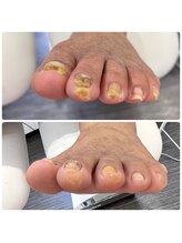 フットファースト 小田原大井町店/厚い爪ビフォーアフター