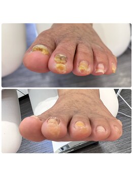 フットファースト 小田原大井町店/厚い爪ビフォーアフター