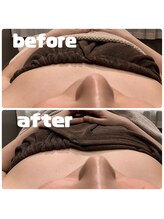 アイリー(IRIE)/光バストケア