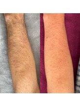 ヒーリングハーツ(Healing Hearts)/メンズシュガーリング脱毛