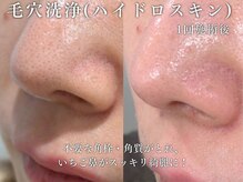 頑固な毛穴を徹底的に除去！毛穴ケア人気NO１『ハイドロスキン』