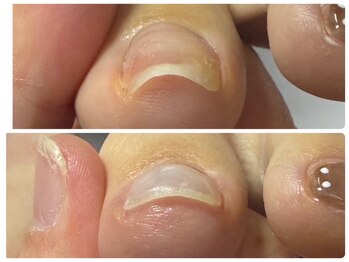 寺子屋ビューティーズ(寺子屋Beauty's)/巻き爪ケア