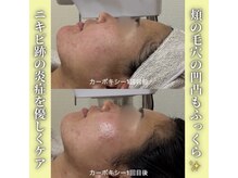 ハニエル(Haniel)/カーボキシー症例