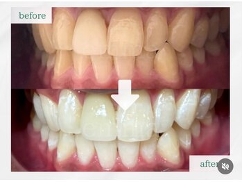 エマ 大橋店(emma)/ブライダルホワイトニング